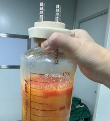 东海水动力吸脂手术要做多久？